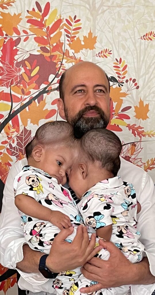 gêmeas siamesas são separadas após 14 horas de cirurgia na Turquia; veja fotos