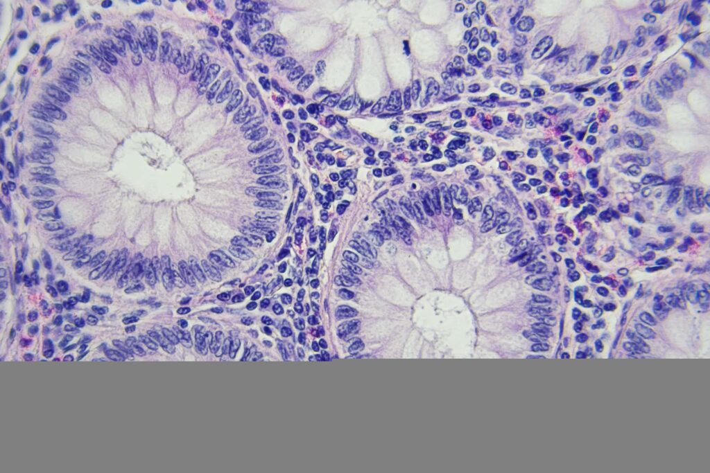 Células de câncer de cólon vista no microscópio