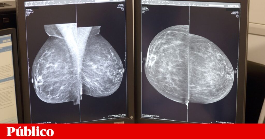 Inteligência artificial identifica risco de cancro na mama com bastante antecedência | Cancro