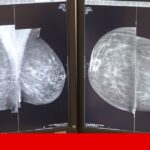 Inteligência artificial identifica risco de cancro na mama com bastante antecedência | Cancro